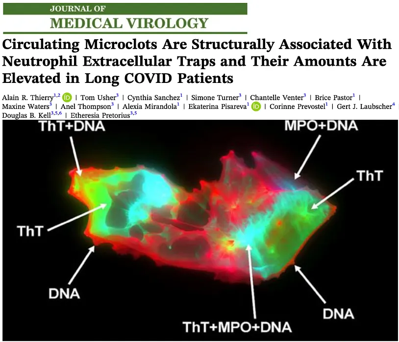 Circulating Microclots Are Structurally Associated With Neutrophil Extracellular Traps and Their Amounts Are Elevated in Long COVID Patients.