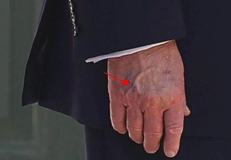 Trump hand