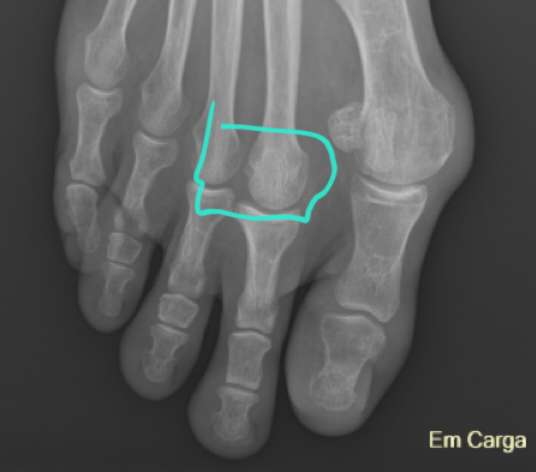 Laurs funky foot.png