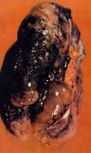 emphysema-lung or is it black lungs.jpg