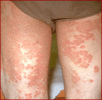 black%20mold%20rash[1].gif