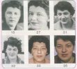 acromegaly.jpg