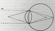 pseudomyopic eye.png