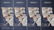spondy grades.PNG