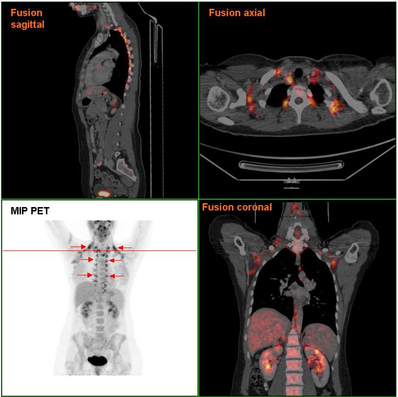 Brownfat_PETCT.jpg