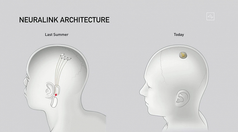 neuralink-1_large.jpg