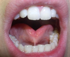 lingual_frenulum-300x243.jpg