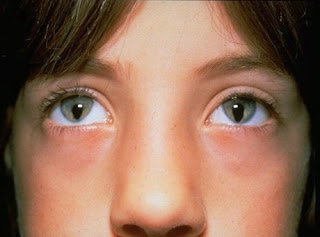 coloboma3.jpeg