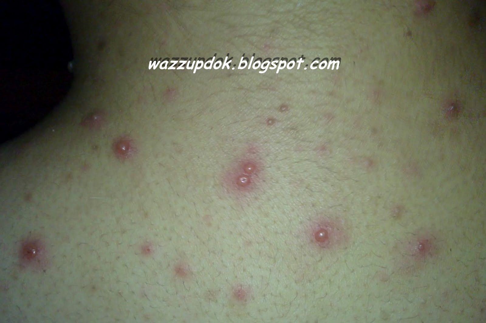 bulutong%2Bchickenpox%2Bzoster.JPG