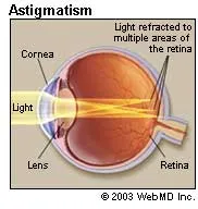 eye_health_astigmatism_eyes_astigmatism2.jpg