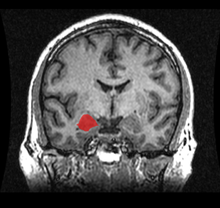 220px-MRI_Location_Amygdala_up.png