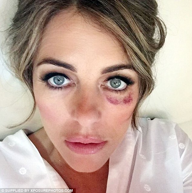 Conspiracy theorists have come up with a bizarre reason for why celebrities have sported black left eyes. Elizabeth Hurley shared a snap of herself with bruising in 2017  Conspiracy theorists have come up with a bizarre reason for why celebrities have sported black left eyes. Elizabeth Hurley shared a snap of herself with bruising in 2017